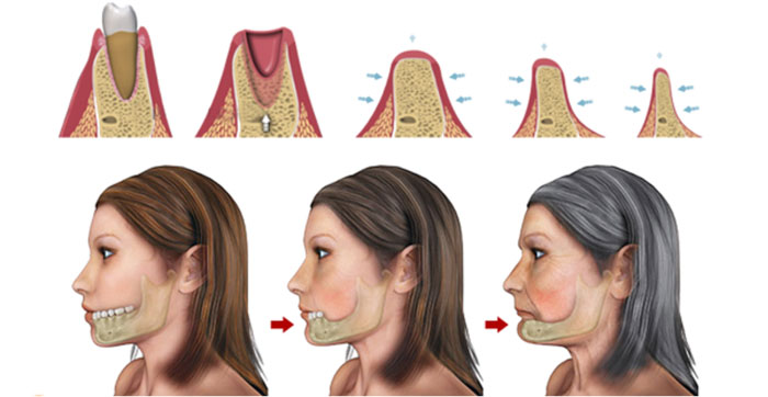 Tiêu xương toàn bộ gương mặt
