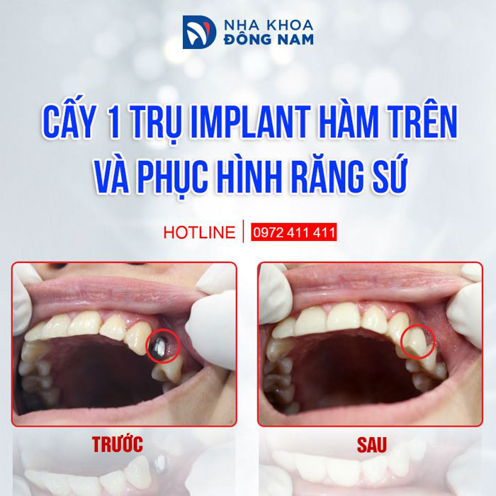 Trồng răng Implant cho răng số 4
