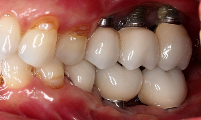 Trụ Implant bị đào thải