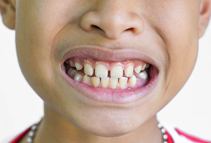 Trường hợp răng thưa khi niềng răng sẽ không cần phải nhổ
