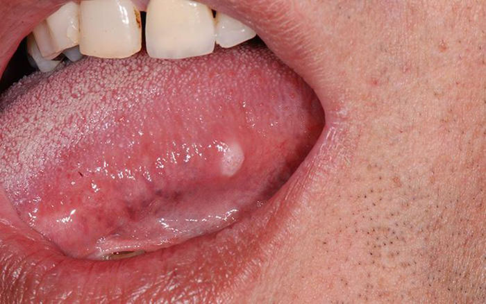 Vết loét miệng do ung thư lưỡi còn kèm theo những u sùi