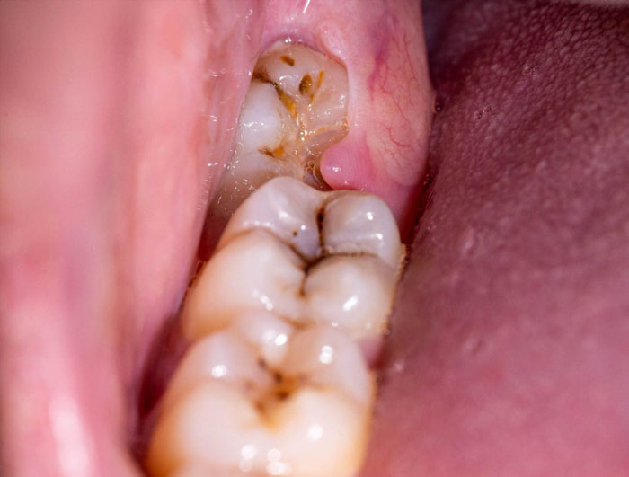 Viêm lợi trùm là tình trạng bề mặt răng bị che phủ bởi nướu