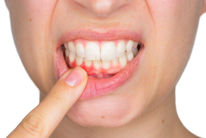 Viêm nướu răng là bệnh lý gây sưng viêm ở mô lợi