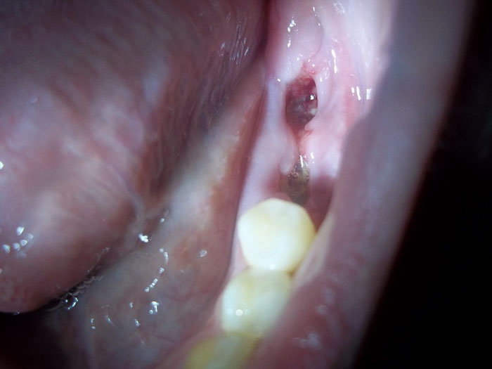 Viêm ổ răng khô là một trong những biến chứng sau khi nhổ răng