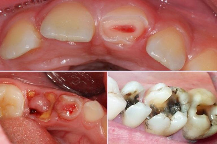 Viêm tủy răng có thể gây sưng đau dai dẳng