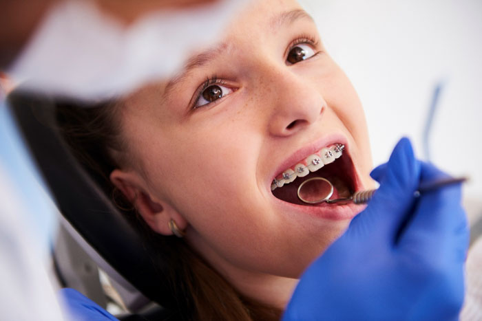 12 – 16 tuổi được xem là thời điểm vàng niềng răng cho trẻ