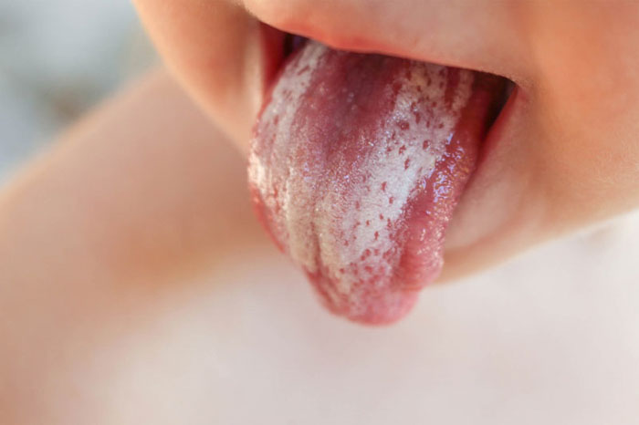Bệnh tưa lưỡi gây ra những mảng trắng trên lưỡi của trẻ