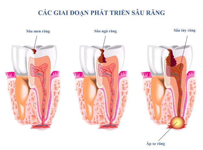 Các giai đoạn phát triển của sâu răng