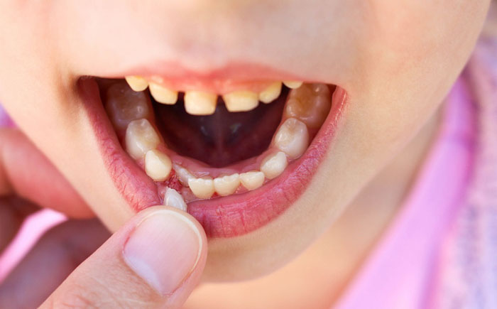 Có nhiều yếu tố góp phần tăng nguy cơ khiến răng của trẻ mọc lẫy