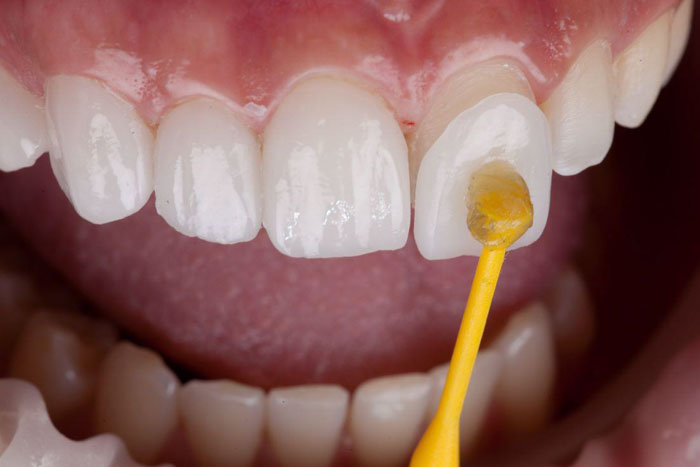 Dán răng sứ có tỷ lệ mài răng rất ít giúp bảo tồn răng tối đa