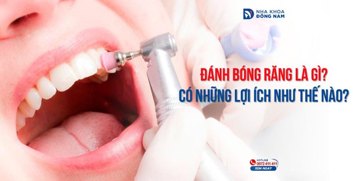 Đánh bóng răng là gì? Có những lợi ích như thế nào?