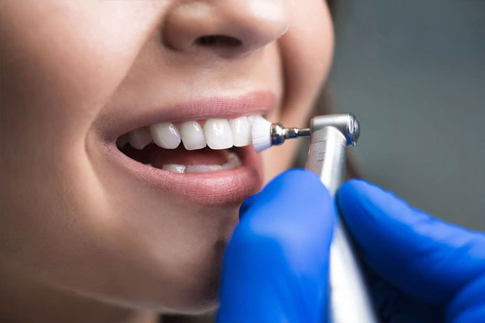 Đánh bóng răng thường được thực hiện sau khi lấy cao răng