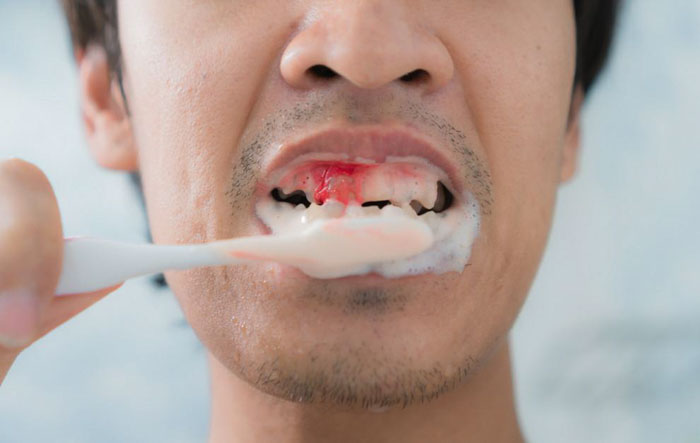Đánh răng sai cách có thể gây chảy máu nướu răng