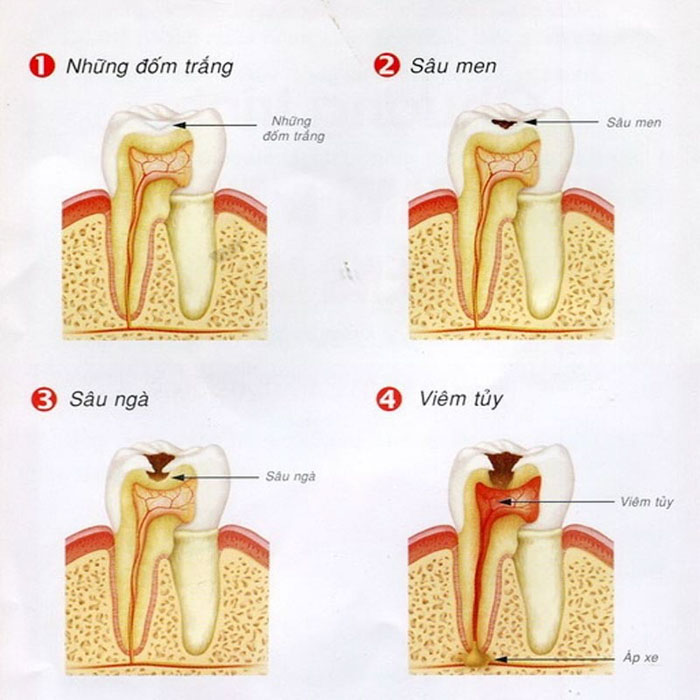 Giai đoạn chớm sâu sẽ xuất hiện các đốm trắng trên răng