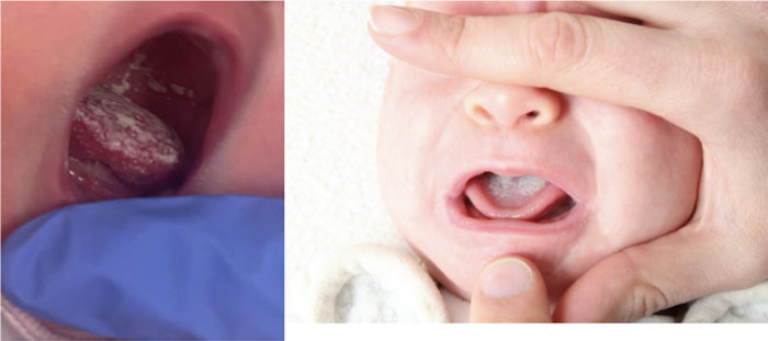 Hình ảnh tưa lưỡi ở trẻ