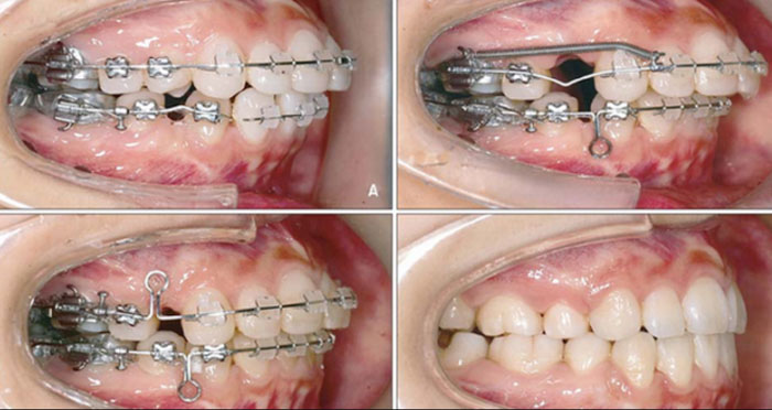 Kéo lùi răng trước ra sau trong trường hợp răng hô