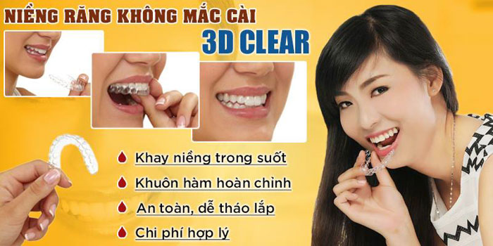 Niềng răng 3D Clear