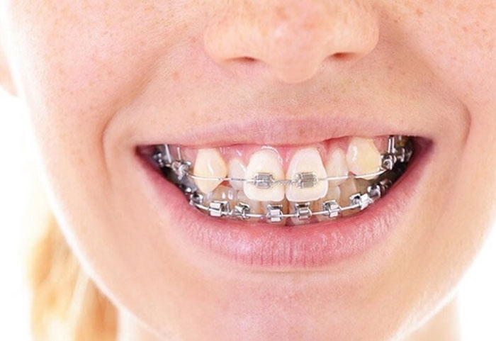 Niềng răng khểnh giúp điều chỉnh răng về vị trí thẳng hàng