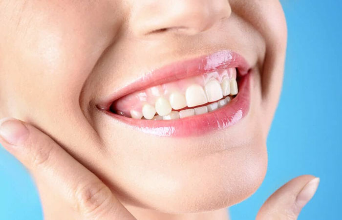 Niềng răng xong bị cười hở lợi khiến nhiều bệnh nhân lo lắng