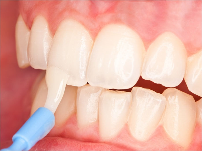 Phương pháp tái khoáng răng