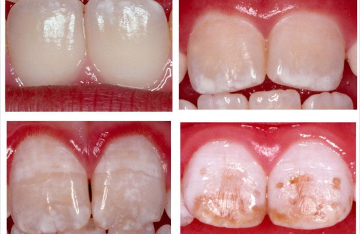 Răng có đốm trắng có thể do bị nhiễm Fluor