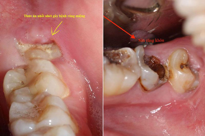 Răng khôn mọc sai lệch dễ gây nhiều bệnh lý nguy hiểm ở răng miệng