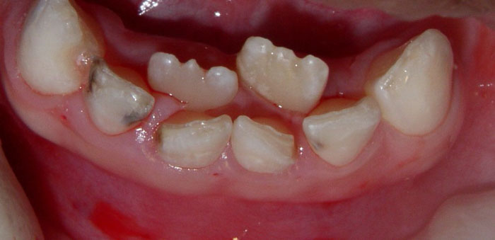 Răng mọc lẫy là tình trạng khá phổ biến ở trẻ