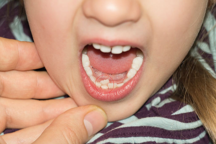 Răng sữa chưa rụng mà răng vĩnh viễn đã mọc lên có thể là dấu hiệu của mọc răng khểnh