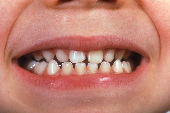 Răng sữa thường có màu trắng đục