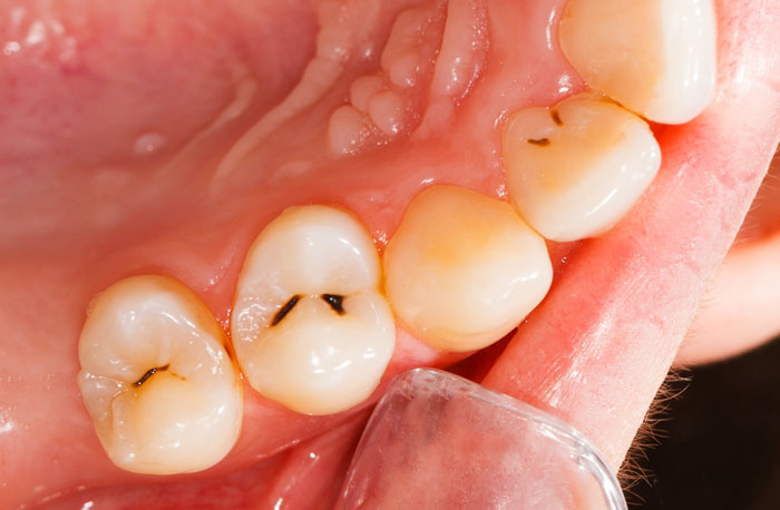 Sâu răng nhẹ với biểu hiện là những đốm đen trên răng