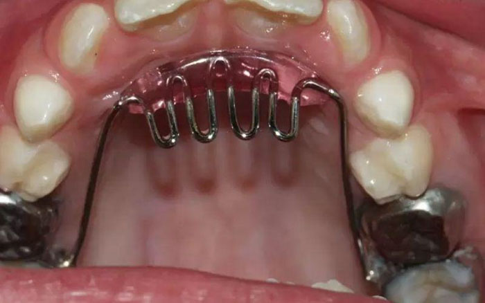 Sử dụng nút chặn lưỡi đặt vào mặt trong của răng cửa