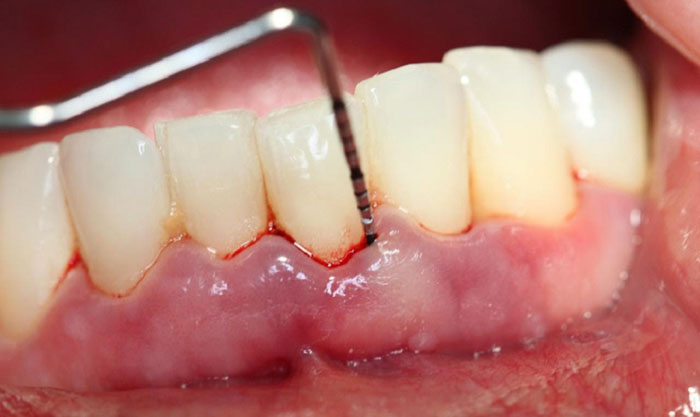 Sưng nướu chảy máu chân răng là những dấu hiệu của viêm chân răng