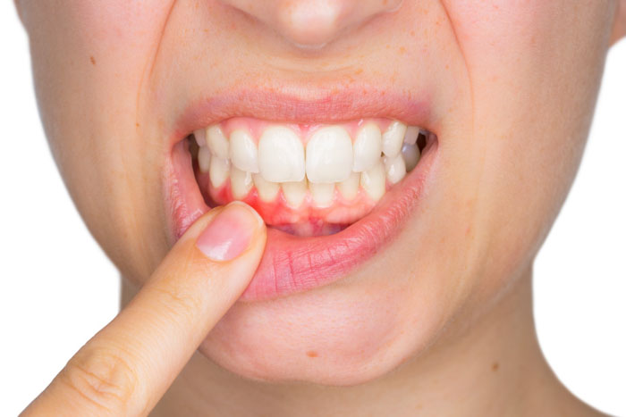 Tẩy trắng răng không được khuyến khích cho những người bị viêm nướu