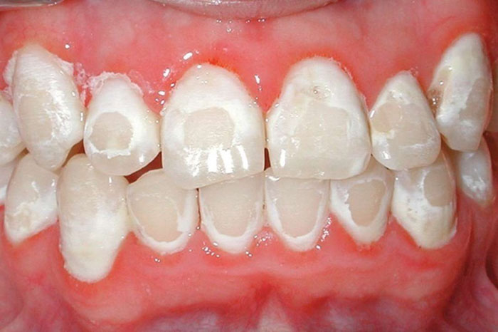 Thừa Flouride khiến răng bị nhiễm độc Fluoride với biểu hiện là những đốm trắng trên răng