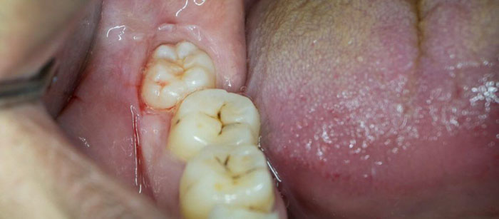 Tổn thương, chảy máu mô mềm khi răng khôn mọc lệch ra má