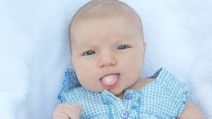Trẻ sơ sinh có miễn dịch kém nên rất dễ bị nấm lưỡi