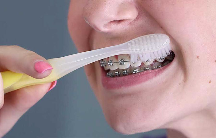 Trong thời gian đeo niềng cần có chế độ chăm sóc răng đúng cách