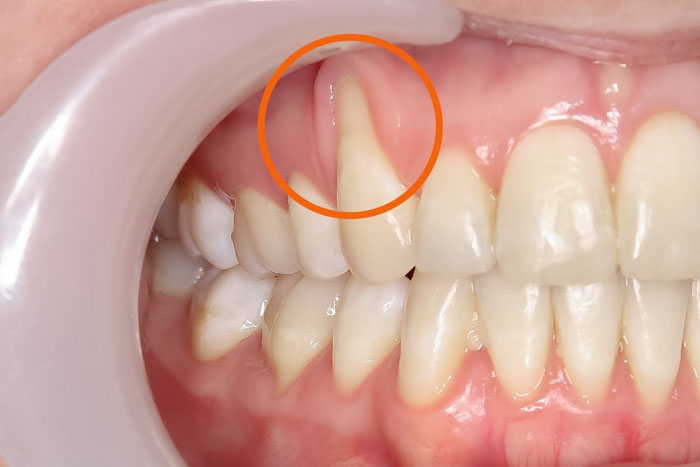 Tụt lợi làm cho răng trông dài hơn bình thường
