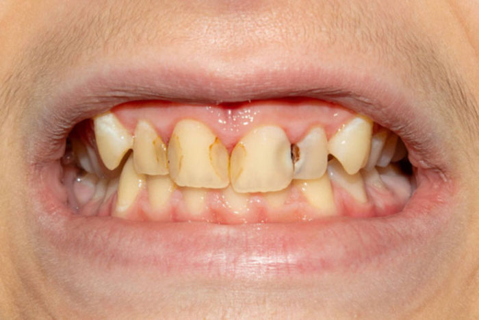 Vết đen ở giữa hai răng là dấu hiệu của sâu kẽ răng