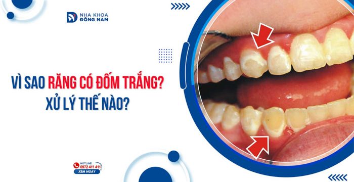 Vì sao răng có đốm trắng? Xử lý thế nào?