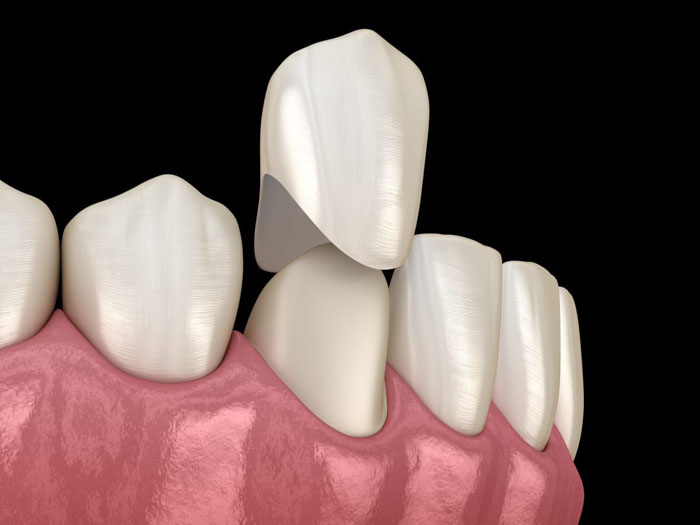 Bọc răng sứ giúp khắc phục tình trạng khớp đối đầu ở mức độ nhẹ và rất nhẹ