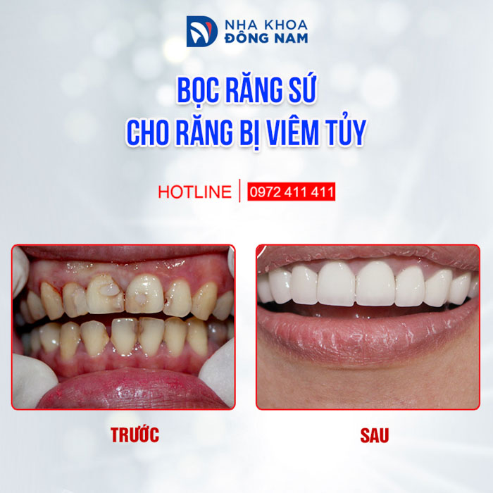 Bọc sứ phục hình cho răng bị viêm tủy