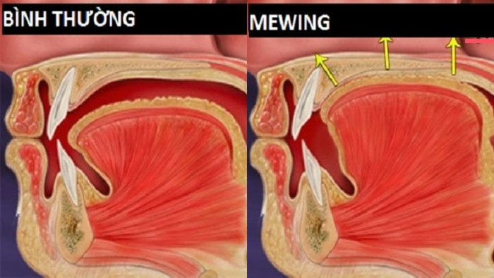 Cơ chế hoạt động của mewing dựa trên tư thế đặt lưỡi và cách thở