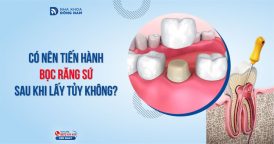 Có nên tiến hành bọc răng sứ sau khi lấy tủy không?