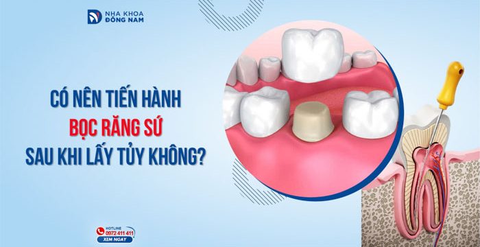 Có nên tiến hành bọc răng sứ sau khi lấy tủy không?