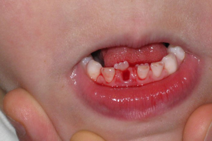 Không nên tự nhổ răng tại nhà cho trẻ để tránh tác hại nguy hiểm