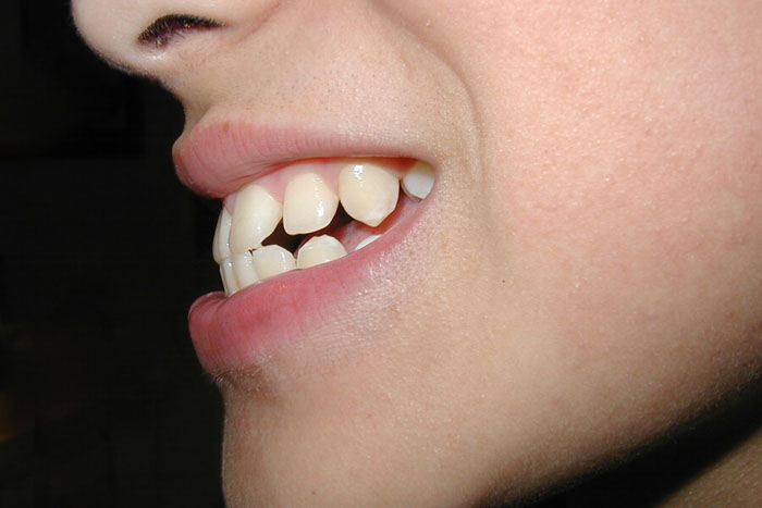 Khớp cắn đối đầu là tình trạng rìa răng cửa hàm trên và hàm dưới chạm vào nhau