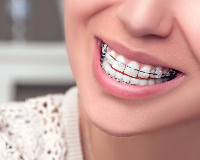 Niềng răng cho khớp cắn đối đầu xuất phát từ nguyên nhân do răng