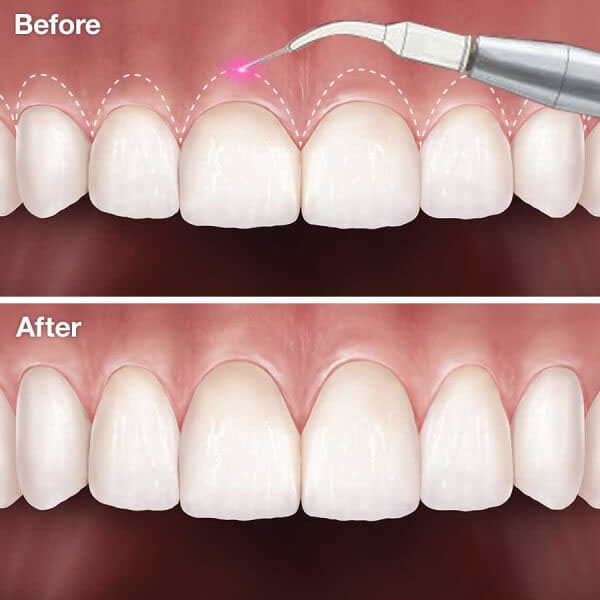 Phẫu thuật cắt nướu giúp loại bỏ phần lợi thừa bám trên răng