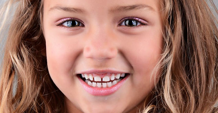 Răng của bé mọc thưa có thể do nhiều nguyên nhân gây nên